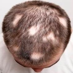 alopecia aerata
