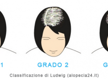 alopecia femminile - scala ludwig
