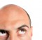 calvizie alopecia androgenetica