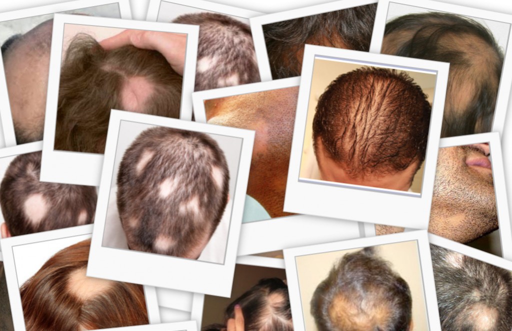 casi di alopecia