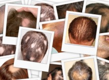 casi di alopecia