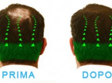 trapianto di capelli - prima e dopo