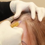 trattamento siringa curare alopecia