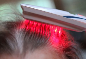 laserterapia alopecia
