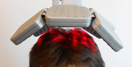 trattamento laser capelli alopecia