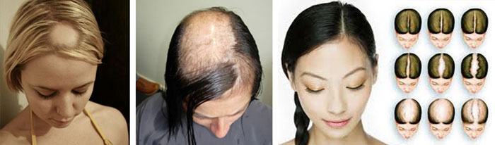 cure alopecia femminile 