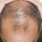 Alopecia Medicina Rigenerativa