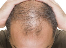 Alopecia Medicina Rigenerativa