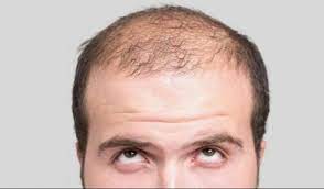 Le principali cause della caduta dei capelli 