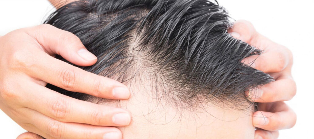 Le principali cause della caduta dei capelli